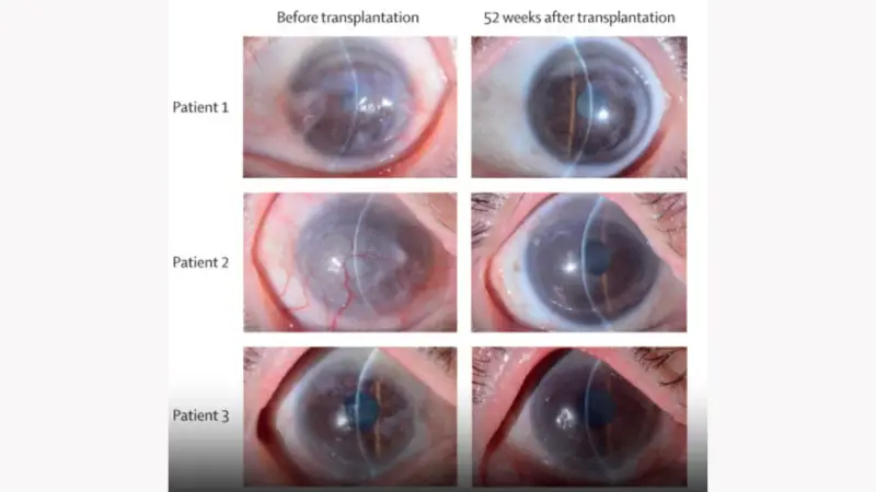 অন্ধজনে পাবে আলো, দৃষ্টিশক্তি পুনরুদ্ধারে যুগান্তকারী সাফল্য!