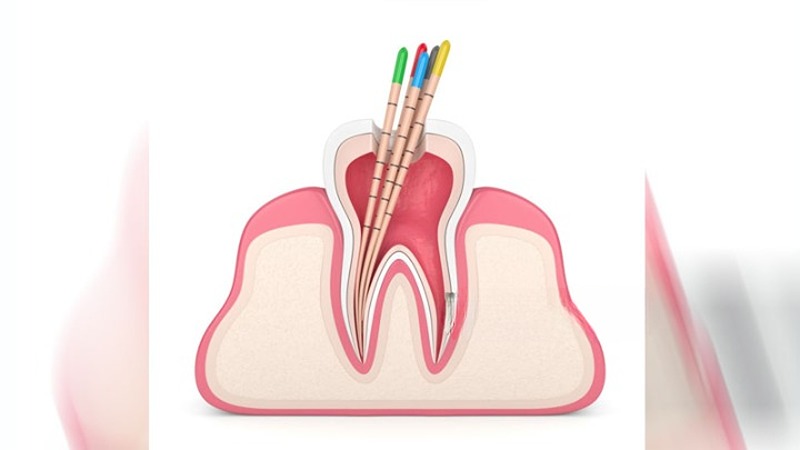 দাঁতের চিকিৎসায় রুট ক্যানেল জরুরি কেন?