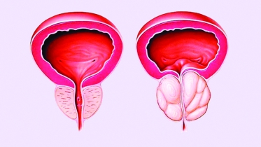 প্রস্টেট গ্রন্থির বৃদ্ধিতে চিকিৎসা