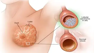 কেন ফিরে আসে স্তন ক্যানসার, গবেষণায় চাঞ্চল্যকর তথ্য