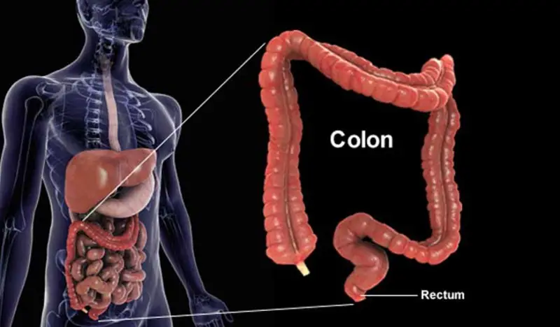যে ছোট লক্ষণ দেখে বুঝবেন কোলন ক্যান্সার হয়েছে 